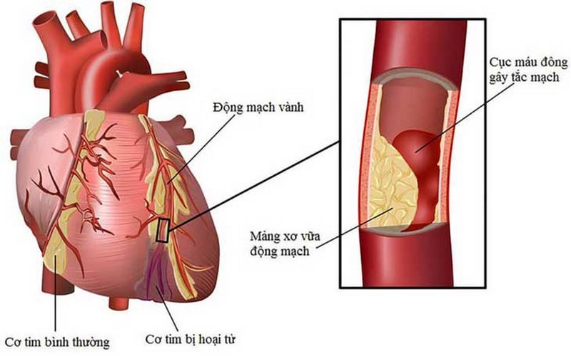 Mạch vành bị tắc nghẽn không đủ oxy nuôi dưỡng