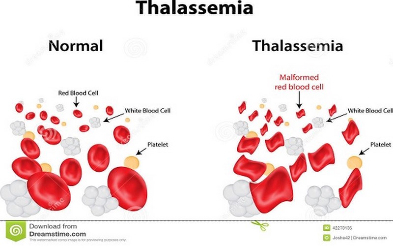 Thalassemia (Thal) là bệnh thiếu máu tán huyết di truyền