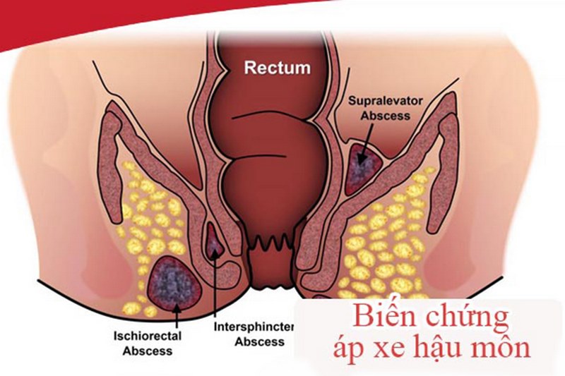 Bác sĩ sẽ kiểm tra vùng hậu môn có bị sưng, đỏ không