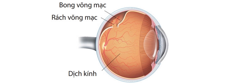 Triệu chứng và dấu hiệu của bong võng mạc