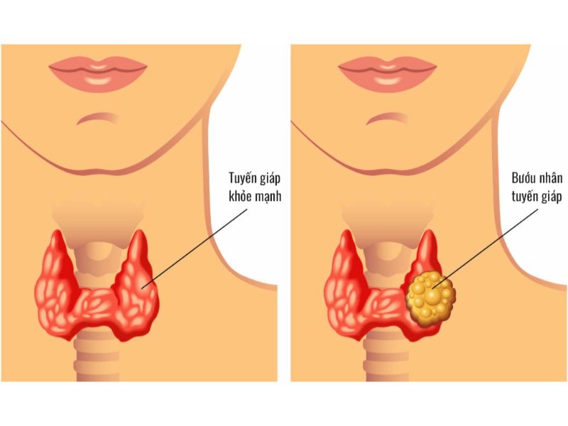 Các nhu mô tuyến giáp phình to gây ra tình trạng bướu giáp nhân (bướu cổ)