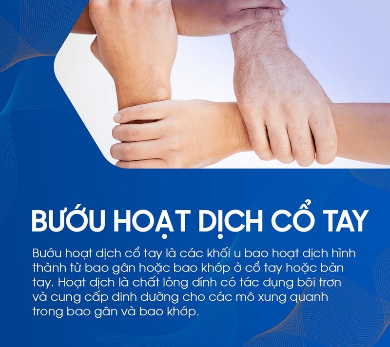 Bướu hoạt dịch cổ tay là gì? Chẩn đoán và cách điều trị