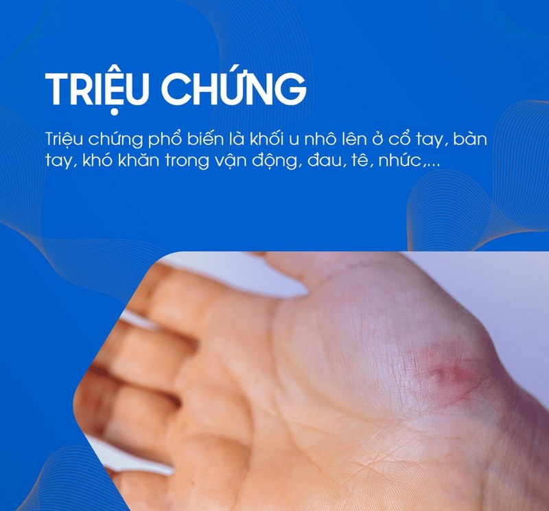 Tìm hiểu chung về bướu hoạt dịch cổ tay