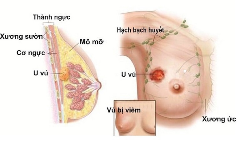 Bướu sợi tuyến Birads 4 gây ra các khối bướu rắn hình tròn và nổi viền ở vú