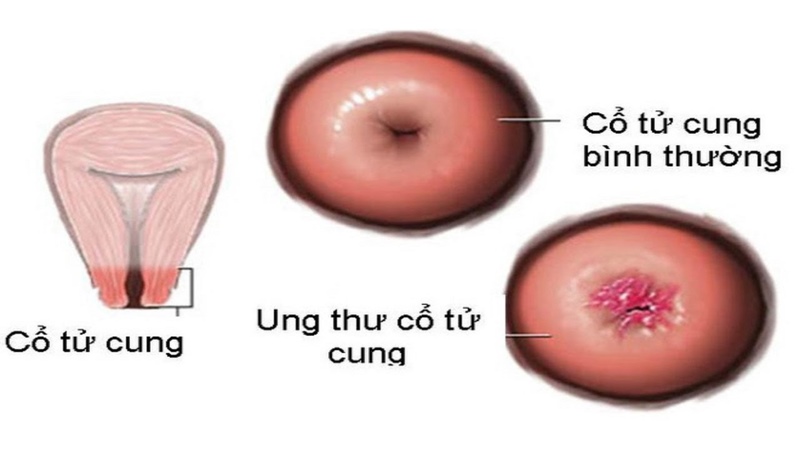 Trong một số trường hợp nghi ngờ, cần phải loại trừ ung thư ở người có chít hẹp cổ tử cung