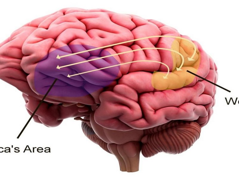 Chứng mất ngôn ngữ là gì?