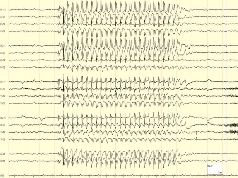 Điện não đồ (EEG) của người bệnh trong cơn động kinh vắng ý thức