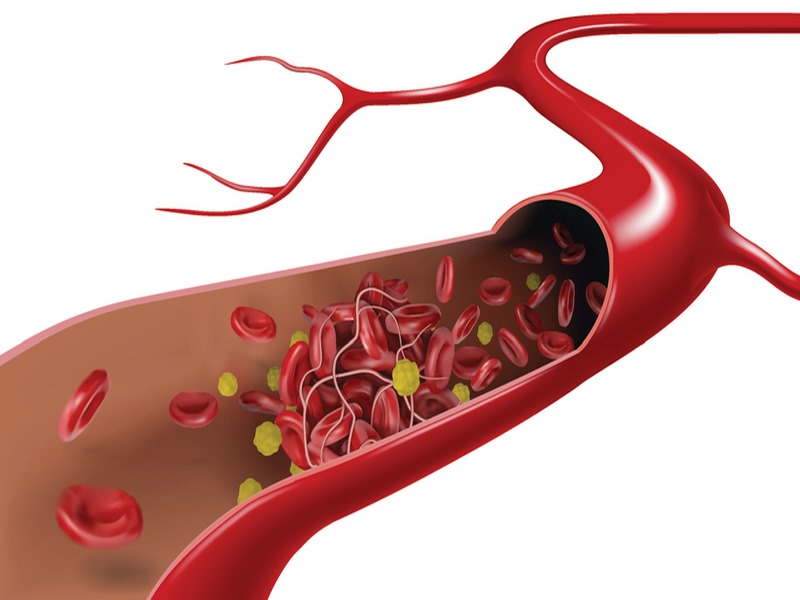 Sự tắc nghẽn mạch máu não do cục máu đông là nguyên nhân hàng đầu