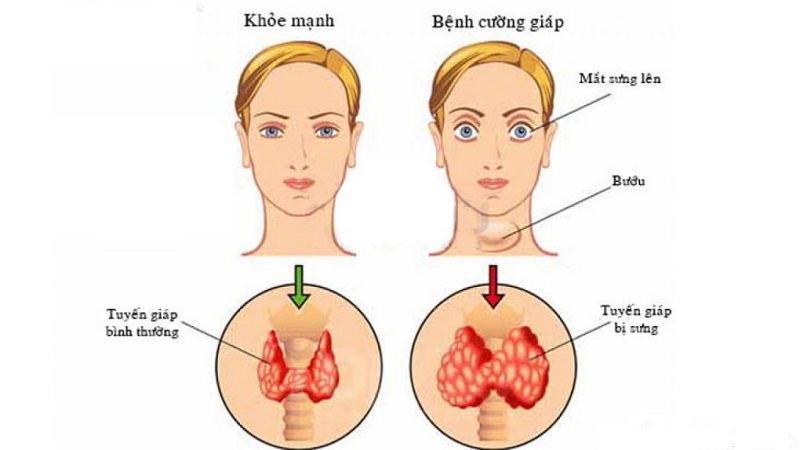 Cường giáp là hội chứng rối loạn tuyến giáp thường gặp