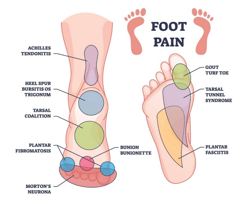 Tìm hiểu chung về tình trạng đau bàn chân