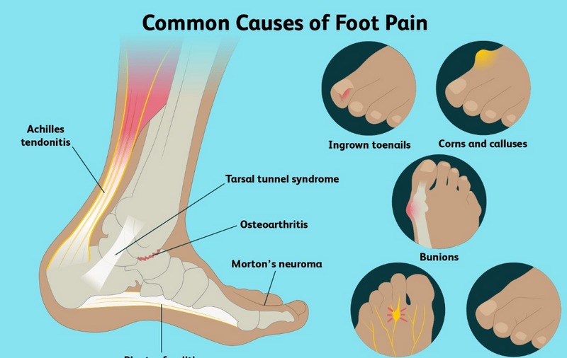 Đau bàn chân: Triệu chứng, phương pháp trị hiệu quả