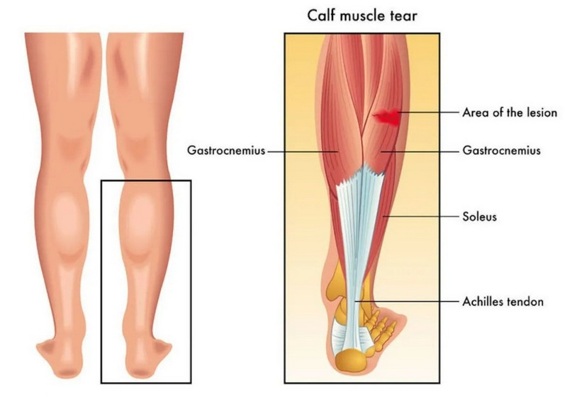 Đau bắp chân? Nguyên nhân gây bệnh và cách phòng ngừa