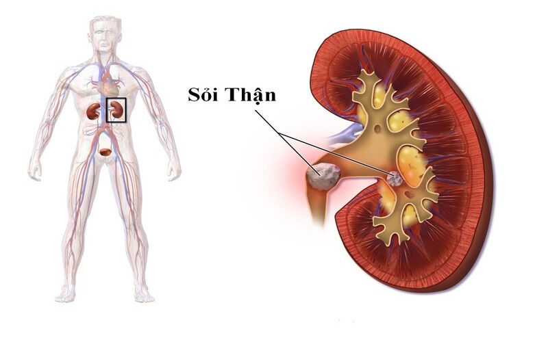 Sỏi thận thường gây đau bụng dưới âm ỉ