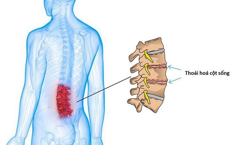 Thoái hóa cột sống có thể là một trong các nguyên nhân gây đau cô 