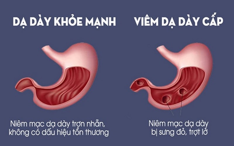 Bao tử bị viêm loét có biểu hiện sưng đỏ