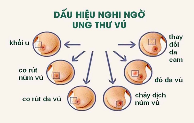 Người bệnh ung thư vú thể tam âm có thể xuất hiện triệu chứng đau ở vú