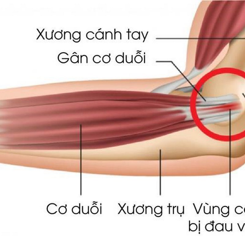 Tìm hiểu chung về đau khớp khuỷu tay