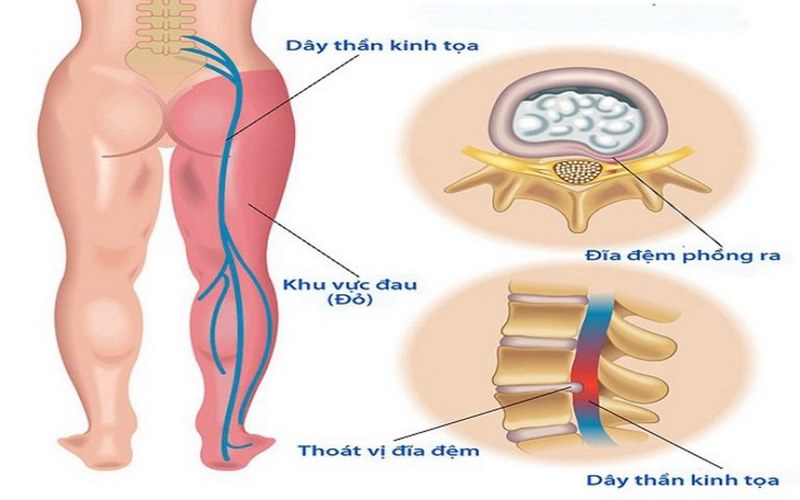 Vị trí dây thần kinh tọa