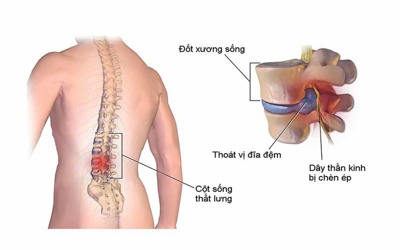 Đau thắt lưng do tổn thương cột sống và rễ thần kinh