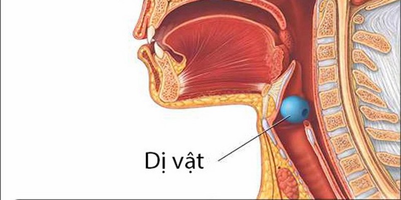 Không đùa giỡn với việc có khả năng nạn nhân đang bị nghẹn