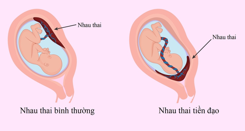 Dính buồng tử cung làm tăng nguy cơ mắc nhau tiền đạo khi mang thai