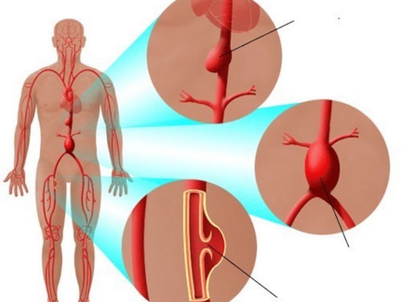 Viêm động mạch chủ là một bệnh nguy hiểm