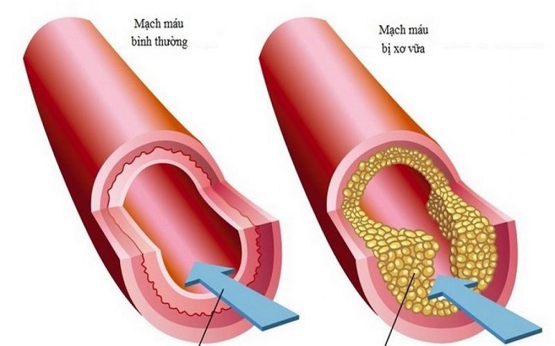 Xơ vữa động mạch - bệnh lý động mạch chủ hay gặp