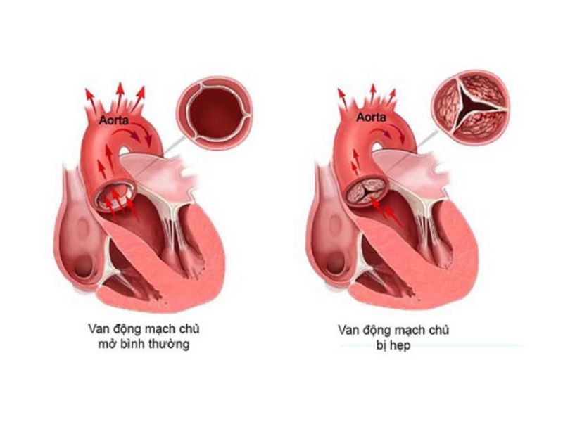 Động mạch chủ bình thường và hẹp van động mạch chủ