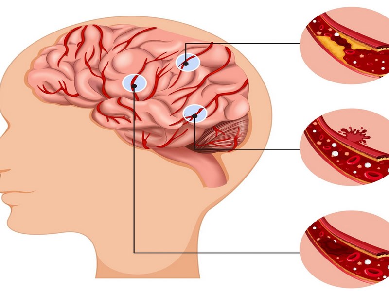 Đột quỵ não là gì?