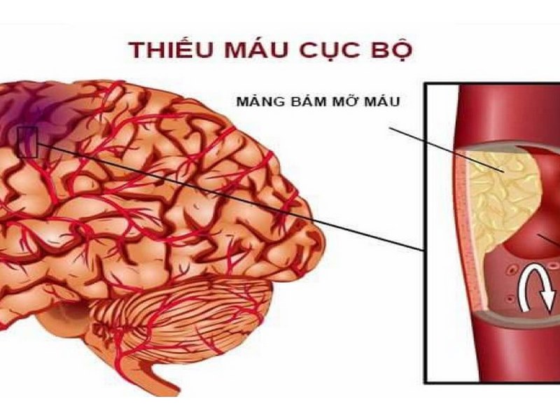 Đột quỵ thiếu máu cục bộ là gì?