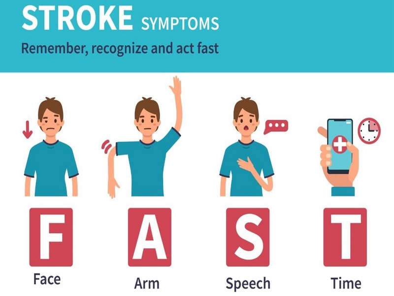 F.A.S.T là bốn đặc điểm dễ nhớ giúp nhận điện và xử lý đột quỵ nhanh chóng