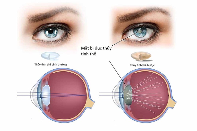 Đục thủy tinh thể do nhiều nguyên nhân gây ra