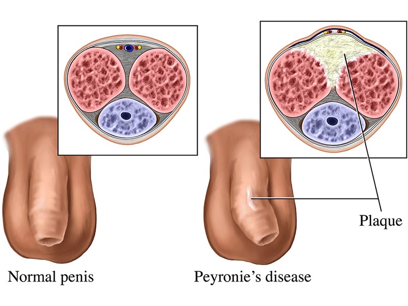 Peyronie’s là nguyên nhân phổ biến của tình trạng dương vật cong