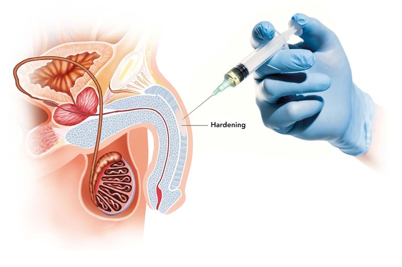 Có nhiều biện pháp điều trị dương vật cong hiệu quả