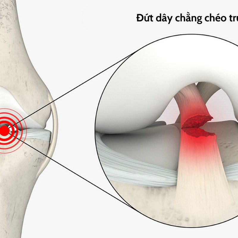 Tìm hiểu chung về đứt dây chằng