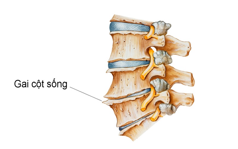 Gai cột sống có hình dáng giống như những mỏm gai