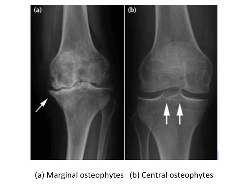 Gai xương ở khớp gối được nhìn thấy trên phim X-quang trong bệnh thoái hóa khớp gối