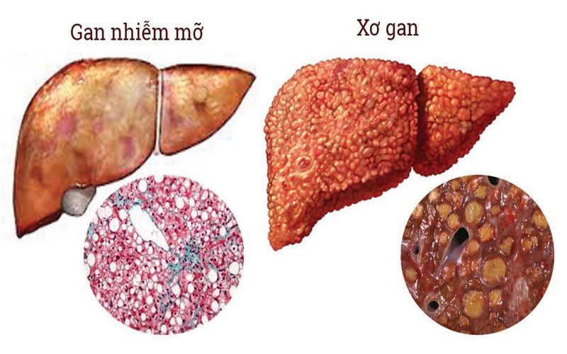 Gan nhiễm mỡ có thể gây gan to, đặc biệt ở những người thừa cân, béo phì