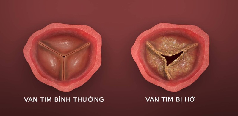 Bệnh cơ tim giãn nở có thể dẫn đến biến chứng hở van tim