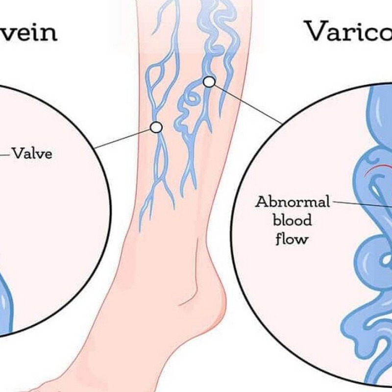 Nguyên nhân dẫn đến giãn tĩnh mạch