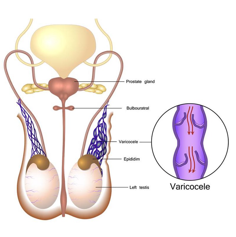 Sự tổn thương các van trong tĩnh mạch thừng tinh làm tĩnh mạch thừng tinh giãn to