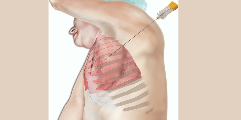 Sinh thiết và làm giải phẫu bệnh được thực hiện để xác định chẩn đoán