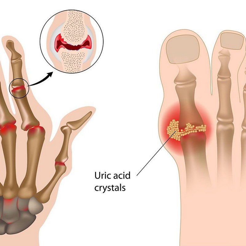 Tìm hiểu chung về Gout cấp tính