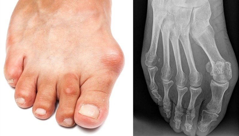 Gout cấp tính là gì? Cách phòng ngừa bệnh hiệu quả