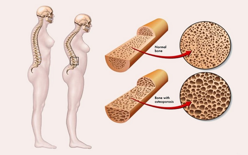 Loãng xương là một trong những nguyên nhân gây gù cột sống