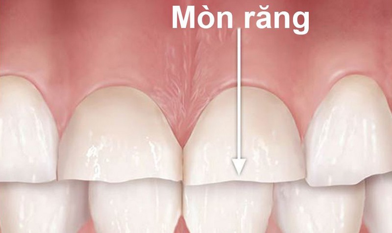 Người nào thường xuyên sử dụng thức uống có ga dễ bị mòn răng