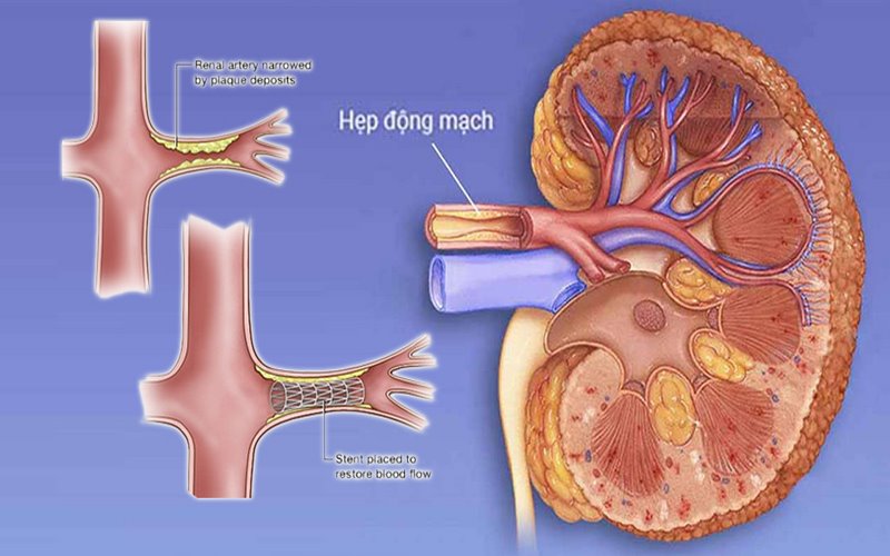 Hẹp động mạch thận làm tăng nguy cơ cao huyết áp ở người trẻ