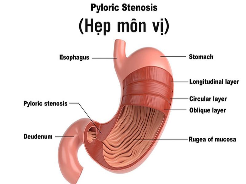 Hẹp môn vị kéo dài có thể gây ra biến chứng nguy hiểm