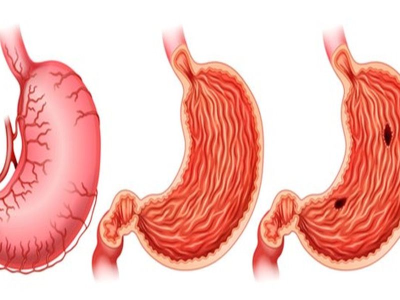 Hẹp môn vị thường không xuất hiện khi mới sinh và có thể phát triển sau