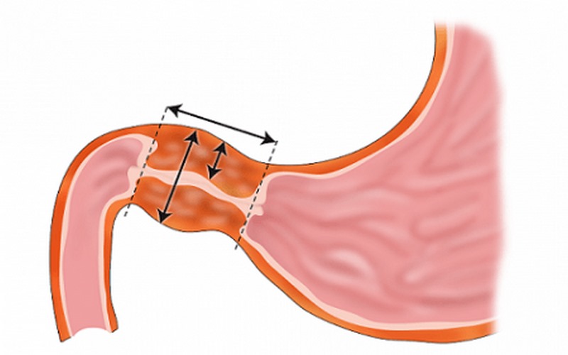 Hẹp phì đại môn vị bẩm sinh là bệnh có sẵn từ khi sinh ra.